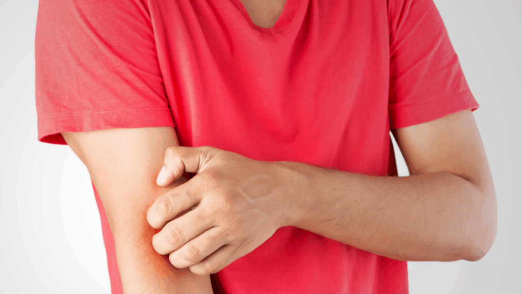 Person with Eczema