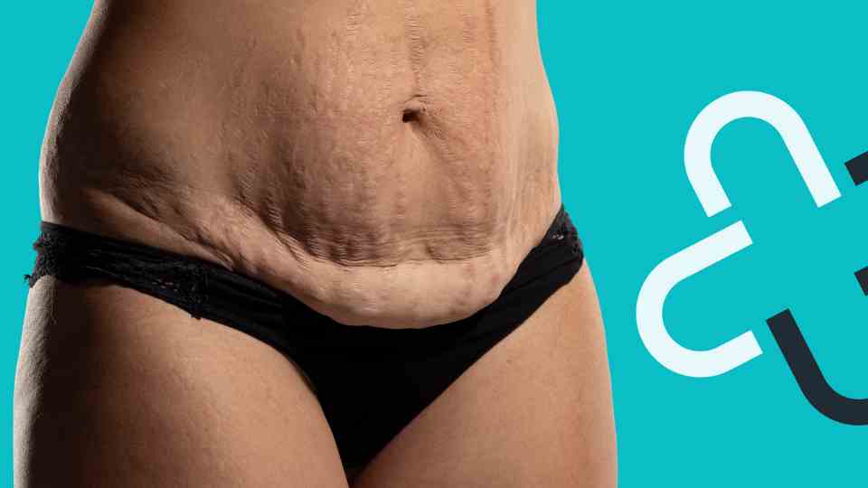 How to avoid loose skin when losing weight